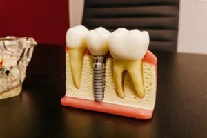 FAQs About Oral Implants Answered